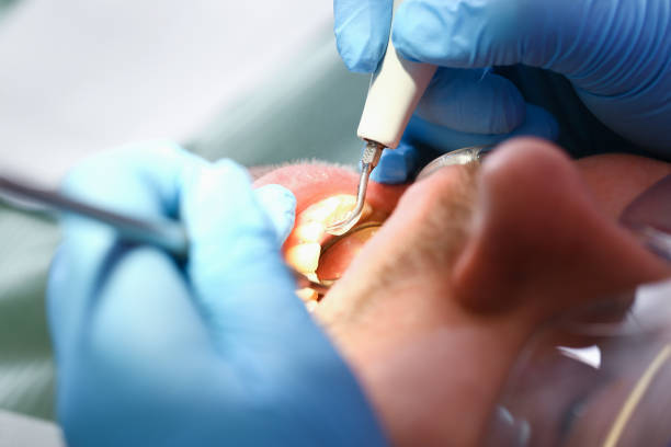 Best Emergency Dentist for Knocked-Out Tooth in Reedspt, OR